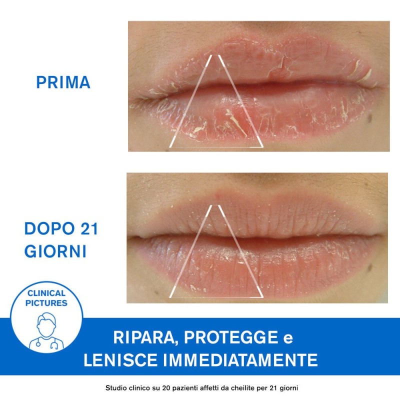 Presentazione grafica di Uriage Barierderm Cica-Levres Balsamo Labbra 15ml Presentazione grafica di Uriage Barierderm Cica-Levres Balsamo Labbra 15ml