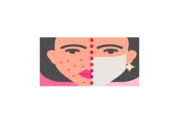 Maskne: cos’è l’acne da mascherina?